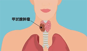 甲狀腺結節愛這四類人，做好這些，改善結節！