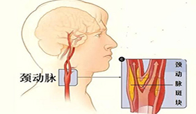 如何預防頸動脈斑塊？