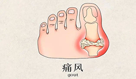 痛風對健康的影響到底有多大？