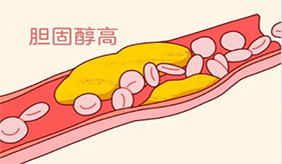 為什么體檢要查膽固醇，膽固醇異常的誘因。
